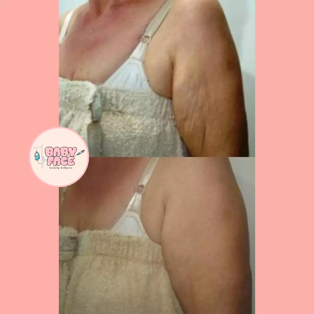 before & After Fotona TightSculpting