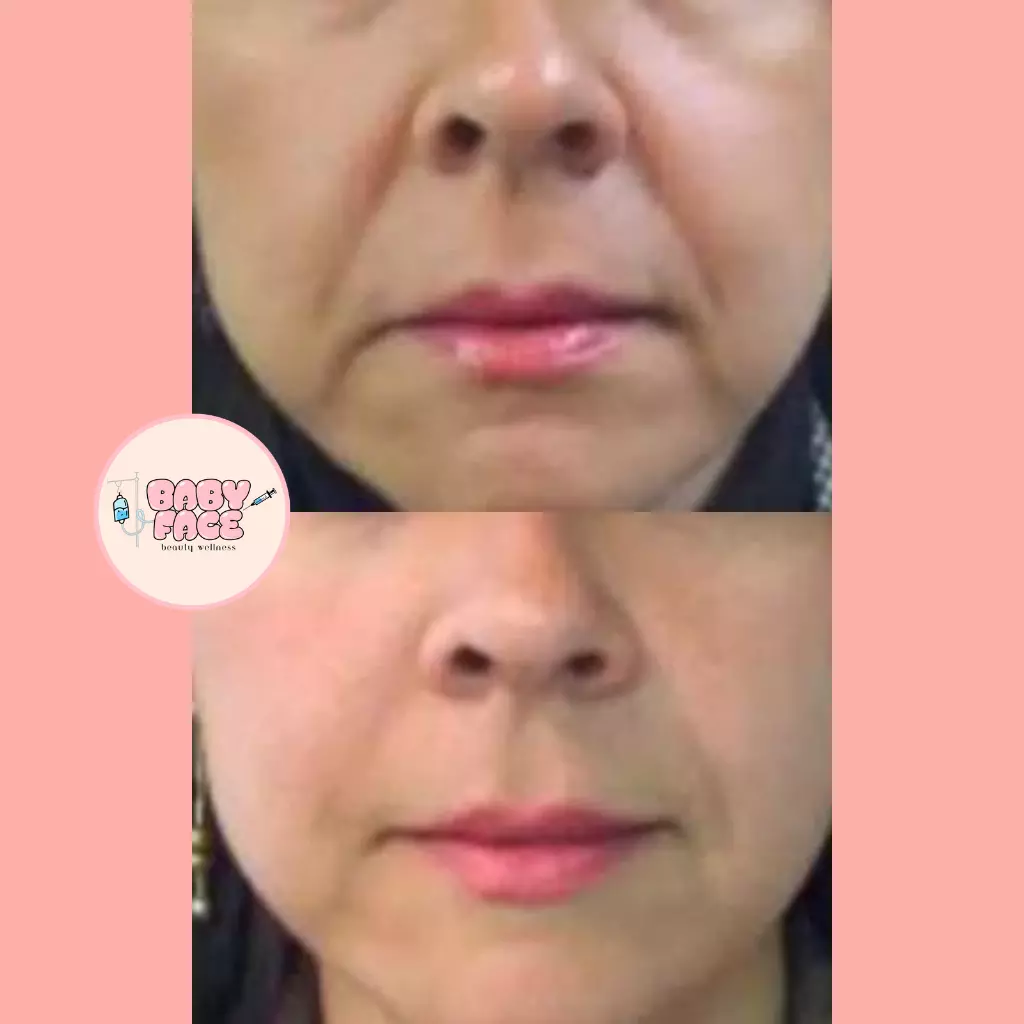 Before & After Intra-Oral Tightening for Nasolabial Folds