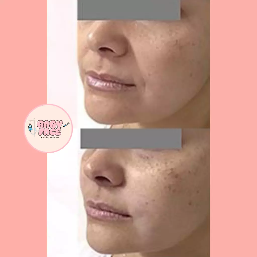 Before & After Intra-Oral Tightening for Nasolabial Folds