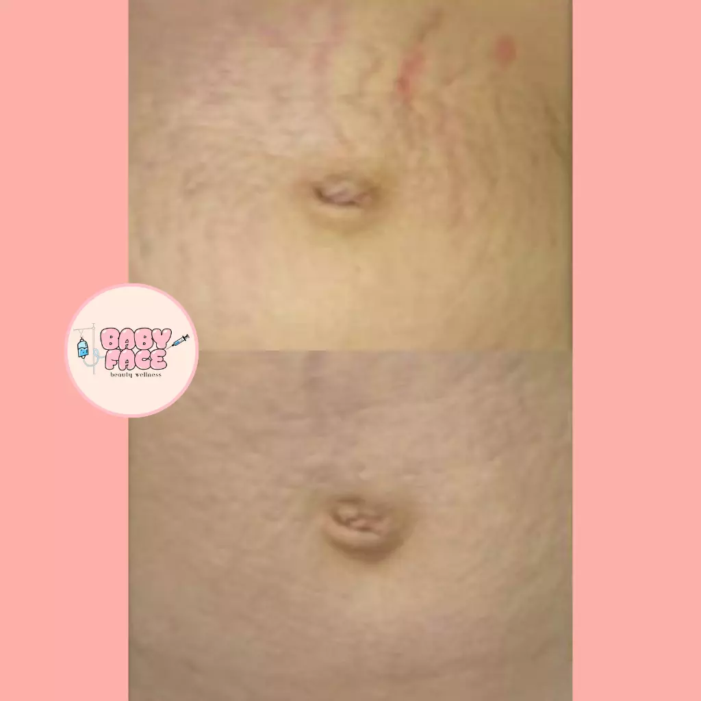 Before & After Laser Stretch Mark Removal