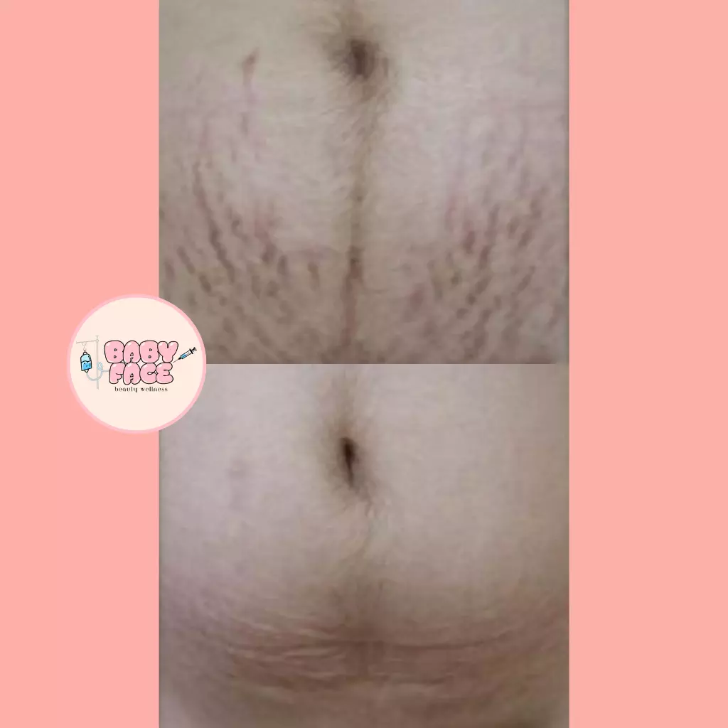 Before & After Laser Stretch Mark Removal