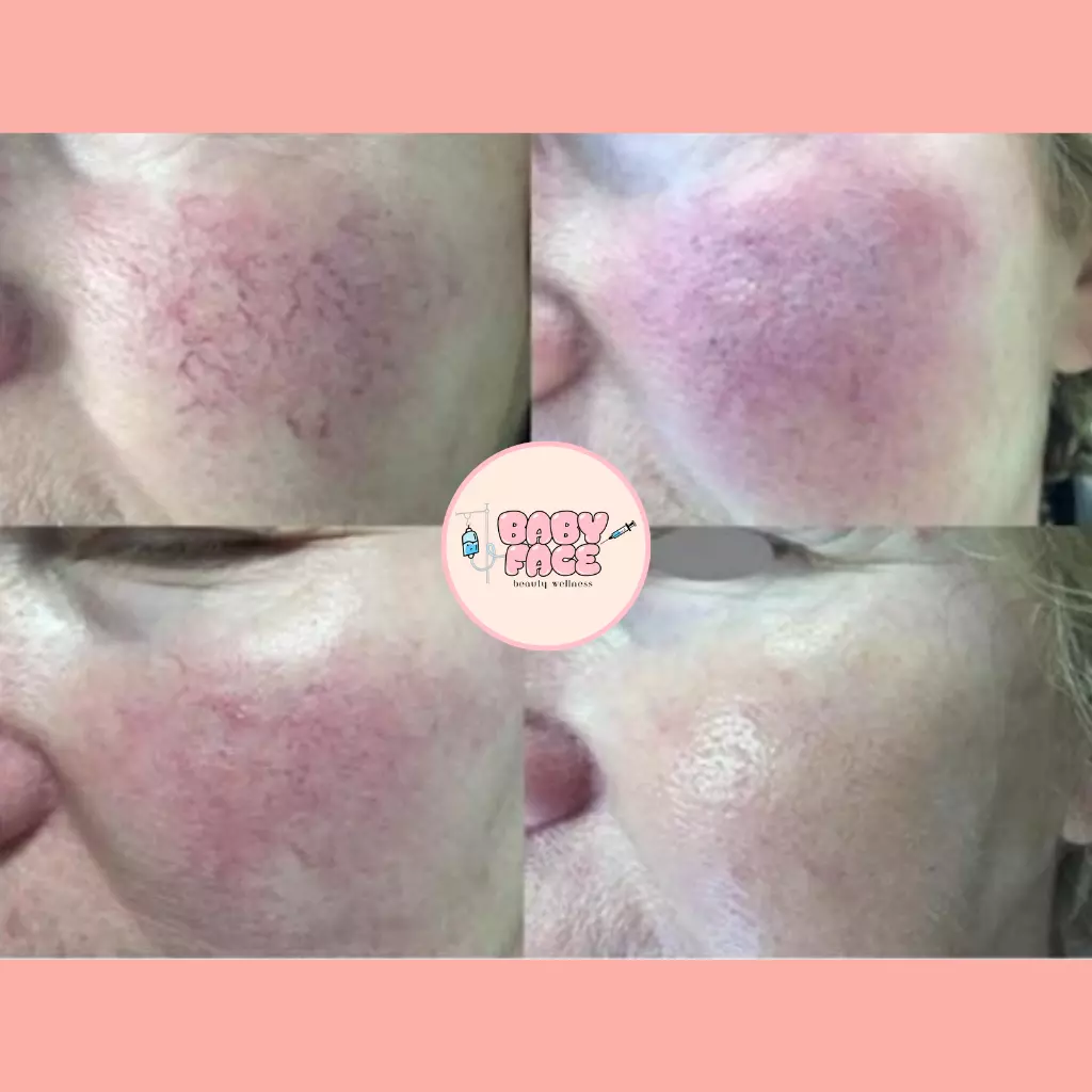 Before & After Laser Treatment for Vascular Lesions: Telangiectasia, Venous Lake & Cherry Hemangioma Removal