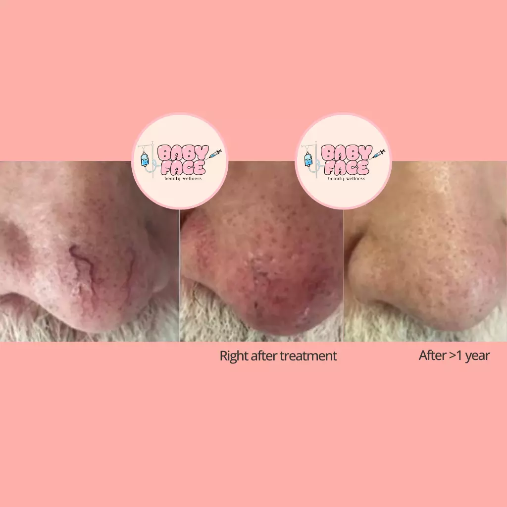 Before & After Laser Treatment for Vascular Lesions: Telangiectasia, Venous Lake & Cherry Hemangioma Removal