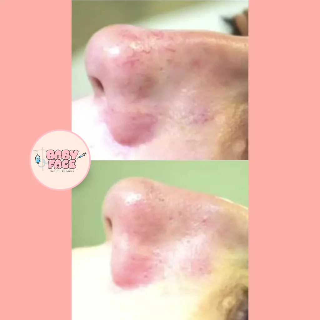 Before & After Laser Treatment for Vascular Lesions: Telangiectasia, Venous Lake & Cherry Hemangioma Removal