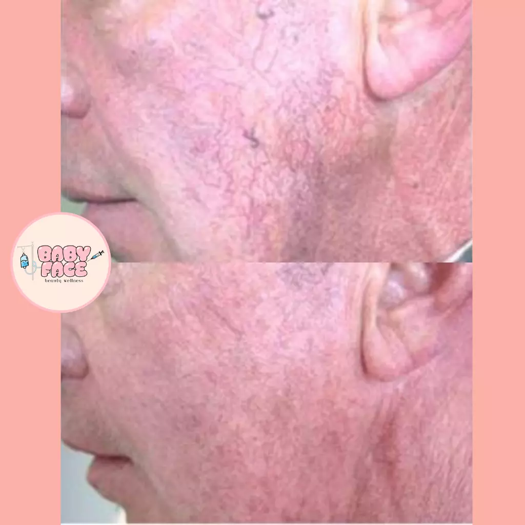 Before & After Laser Treatment for Vascular Lesions: Telangiectasia, Venous Lake & Cherry Hemangioma Removal