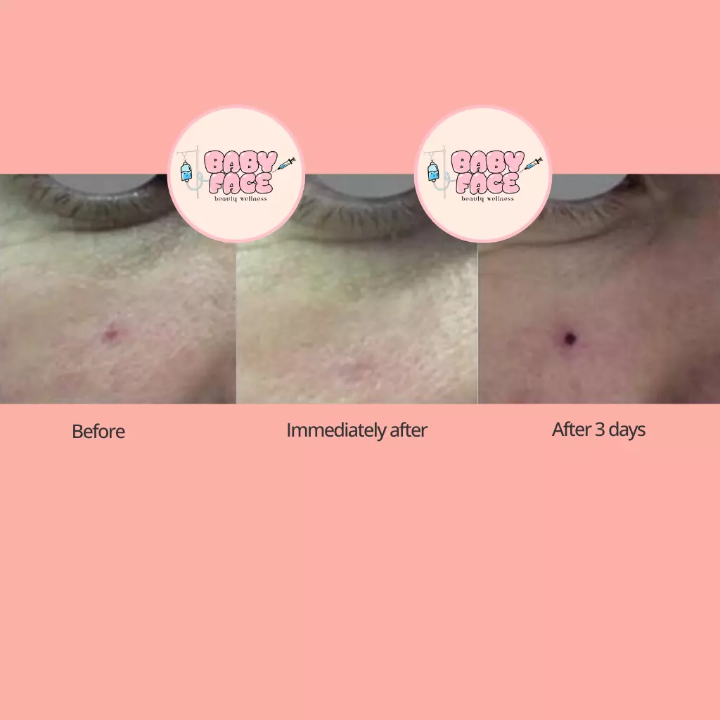 Before & After Laser Treatment for Vascular Lesions: Telangiectasia, Venous Lake & Cherry Hemangioma Removal