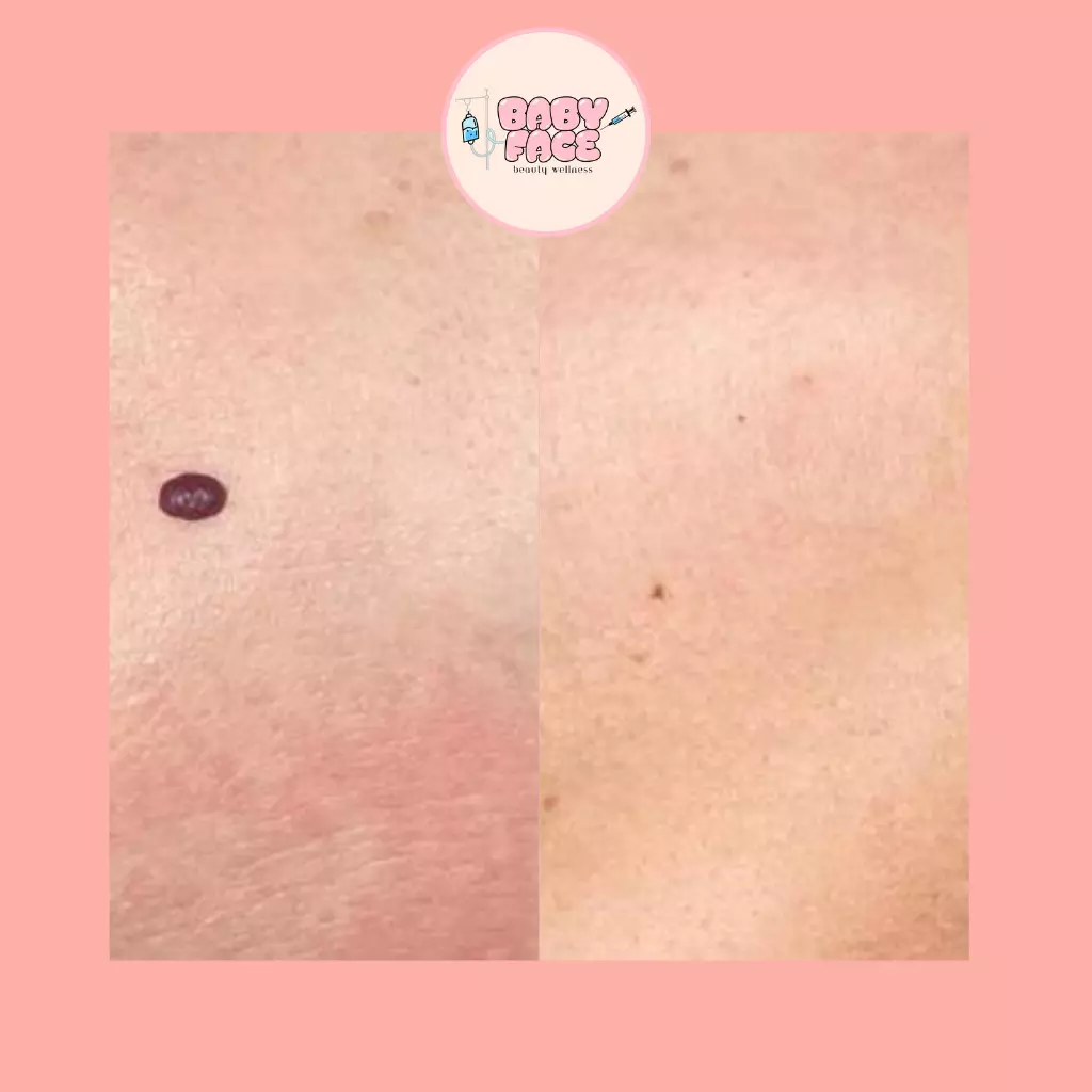 Before & After Laser Treatment for Vascular Lesions: Telangiectasia, Venous Lake & Cherry Hemangioma Removal