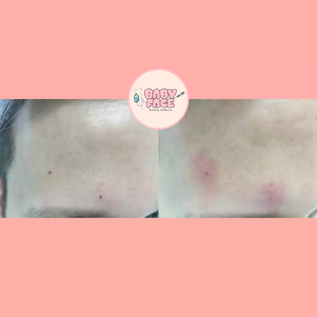 Before & After Laser Treatment for Vascular Lesions: Telangiectasia, Venous Lake & Cherry Hemangioma Removal