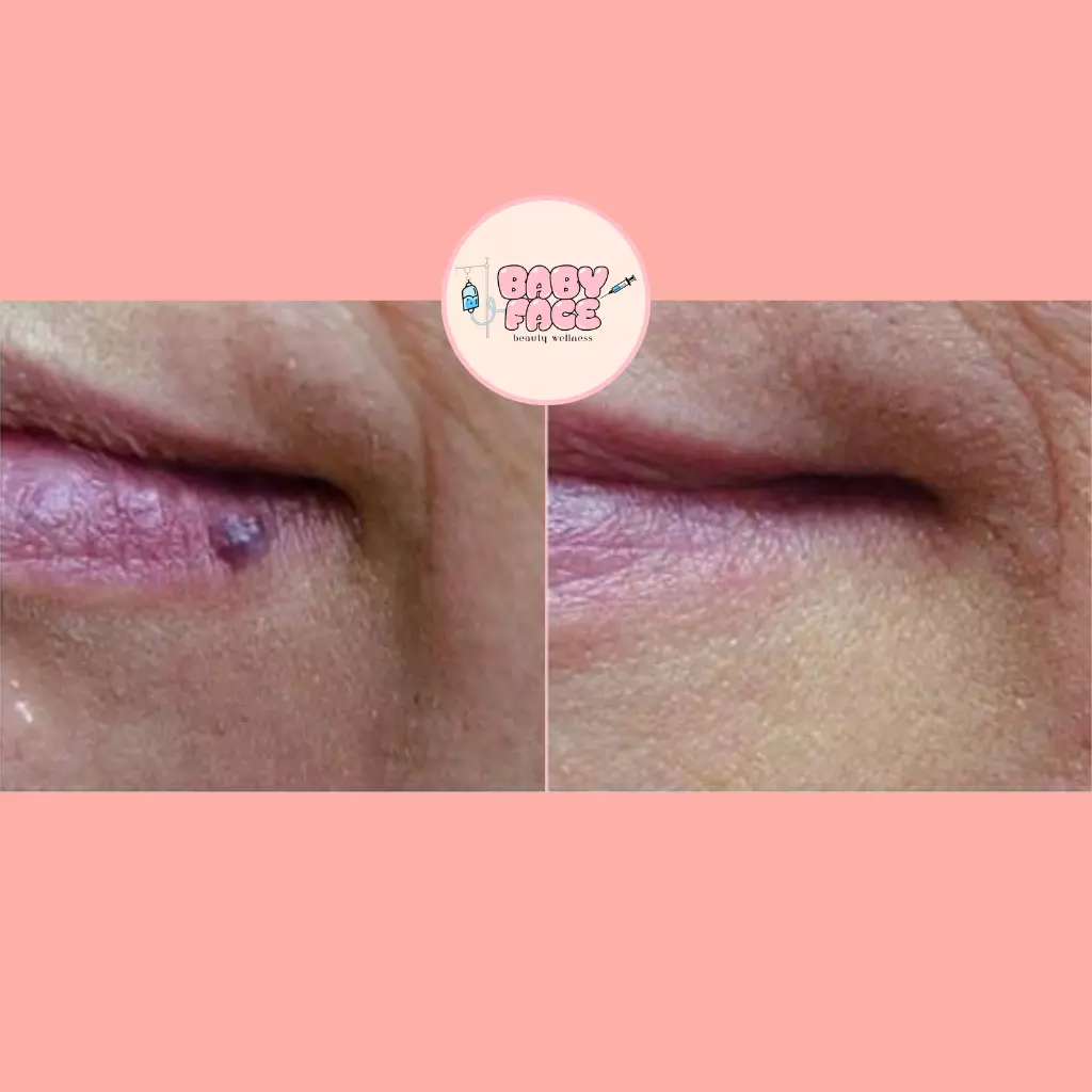 Before & After Laser Treatment for Vascular Lesions: Telangiectasia, Venous Lake & Cherry Hemangioma Removal