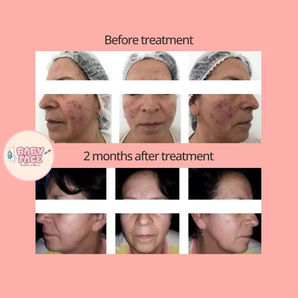 Before & After Rosacea Laser Treatment