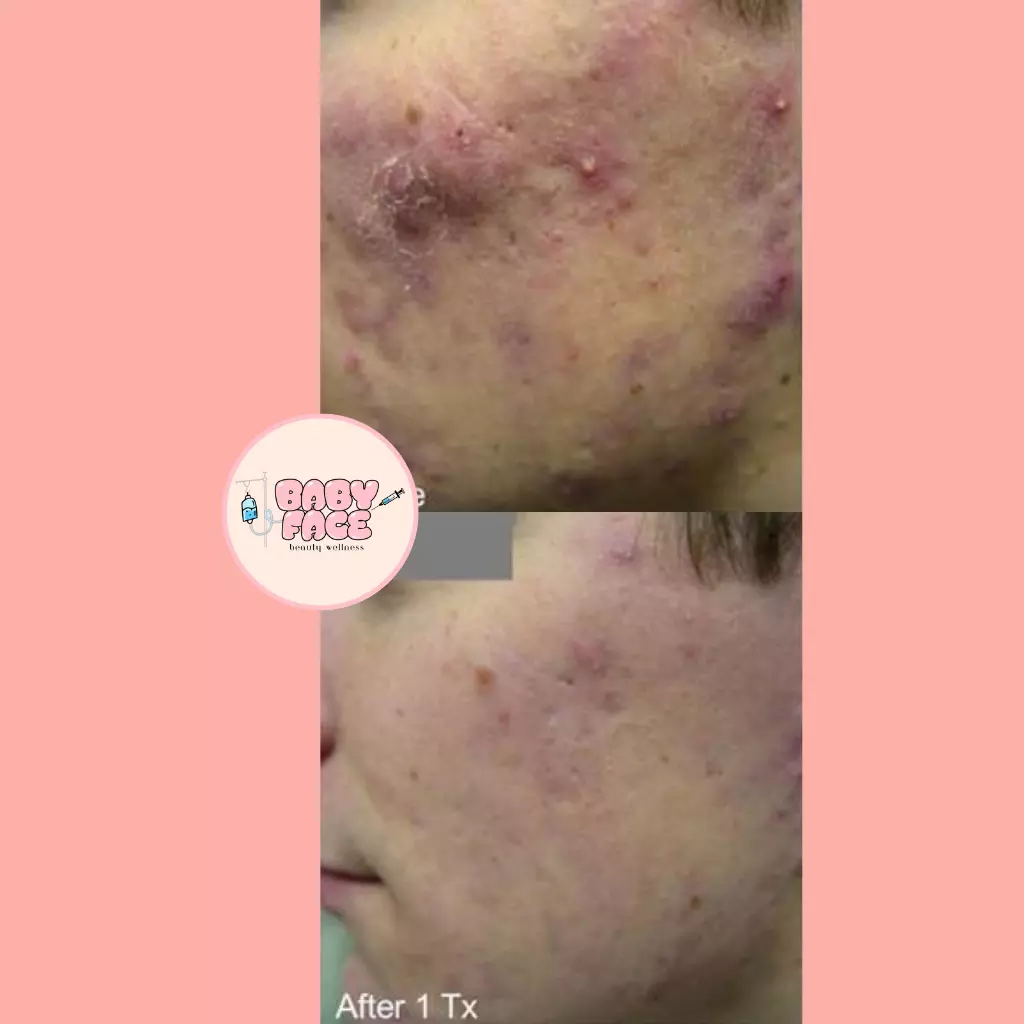 Before & After Laser Acne Removal for Acne Scar Reduction