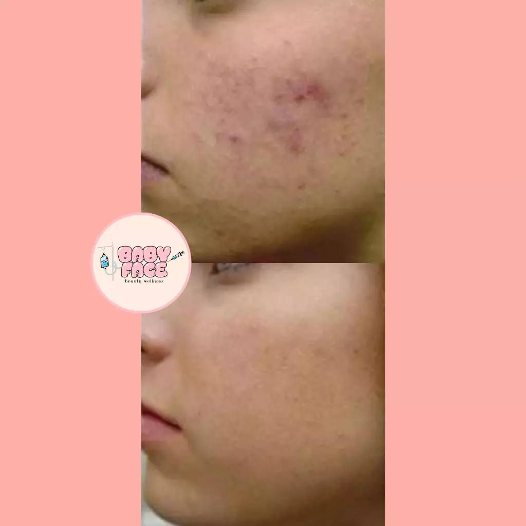 Before & After Laser Acne Removal for Acne Scar Reduction