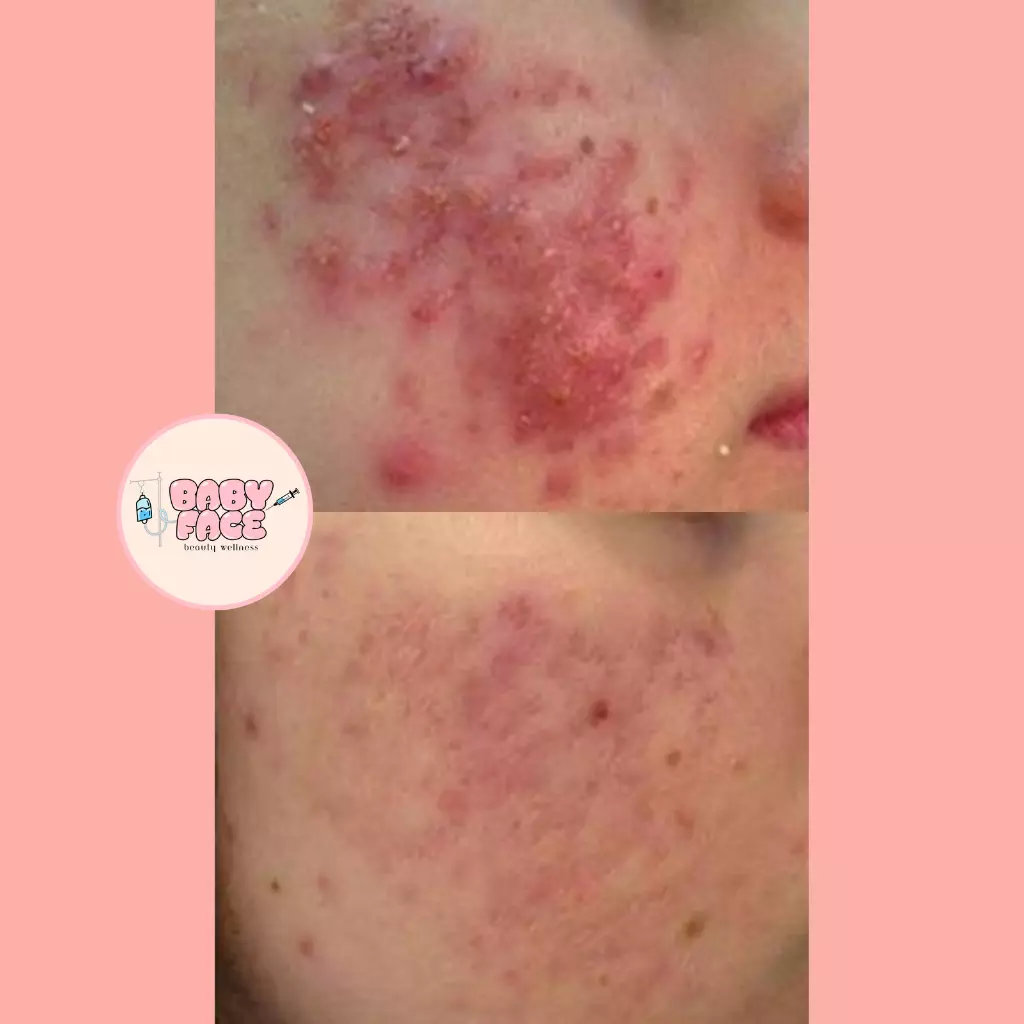 Before & After Laser Acne Removal for Acne Scar Reduction