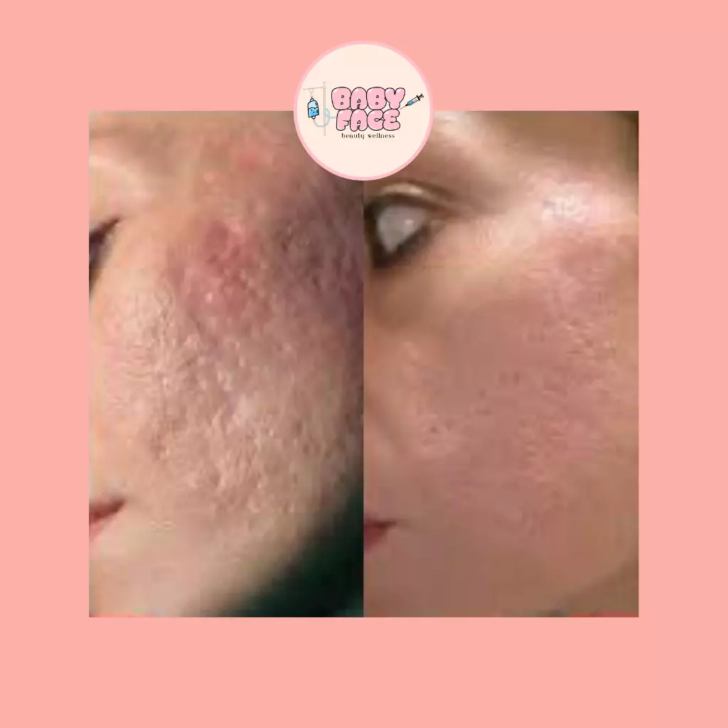 Before & After Laser Acne Scar Removal