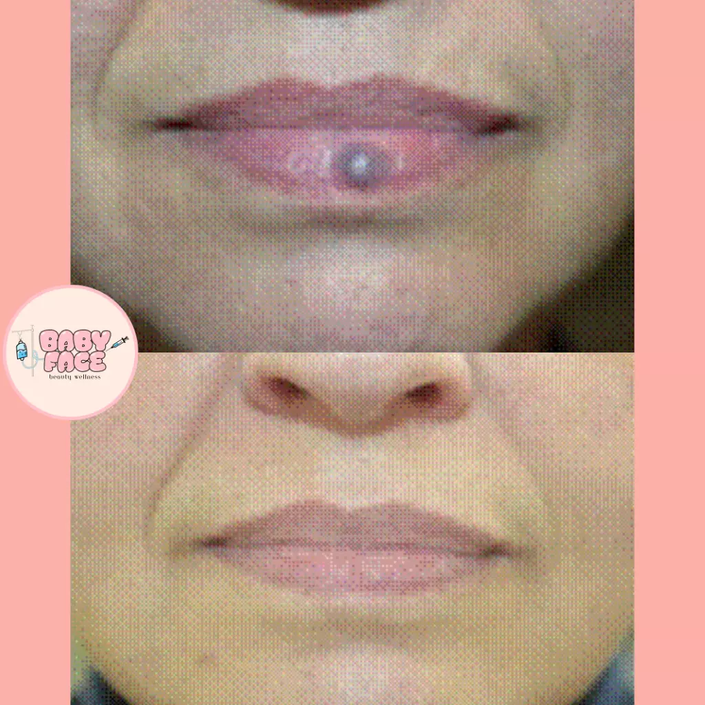 Before & After Laser Treatment for Vascular Lesions: Telangiectasia, Venous Lake & Cherry Hemangioma Removal