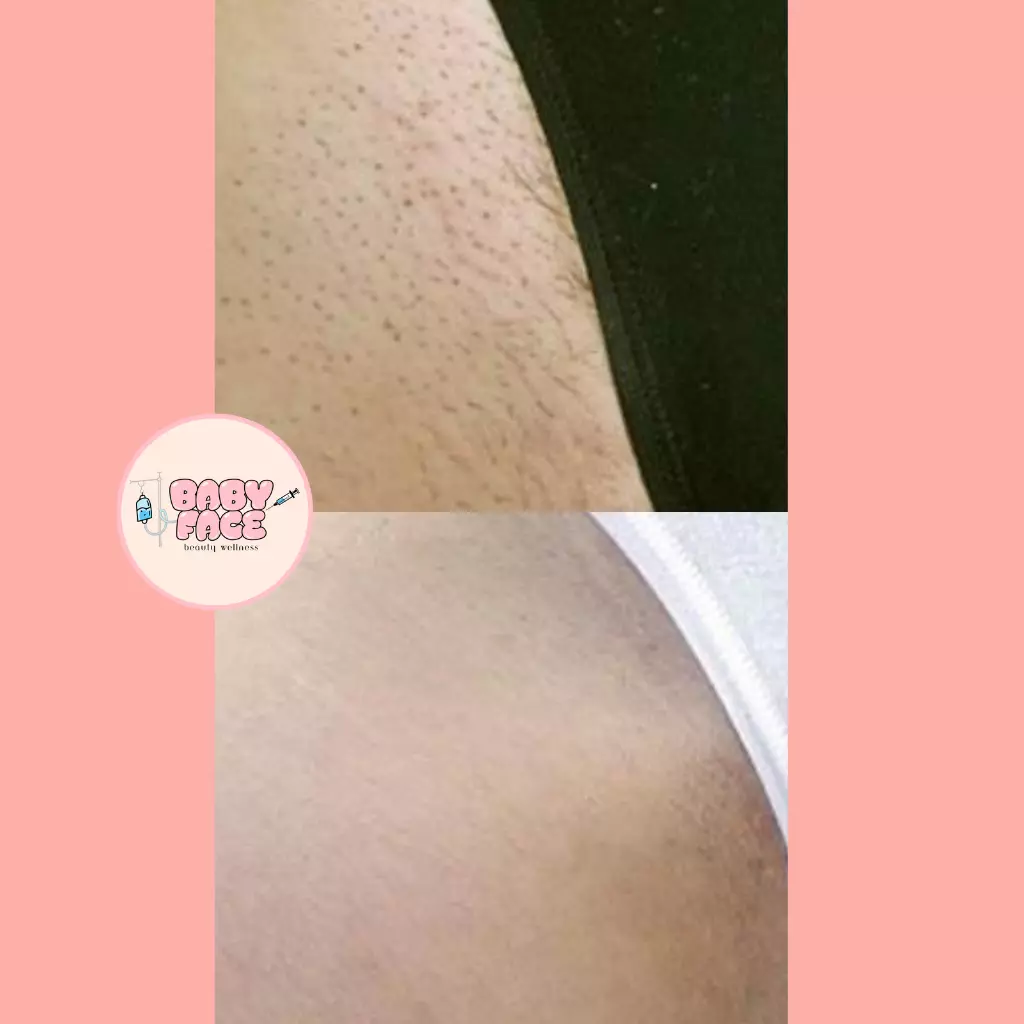 Before & After Laser Hair Removal