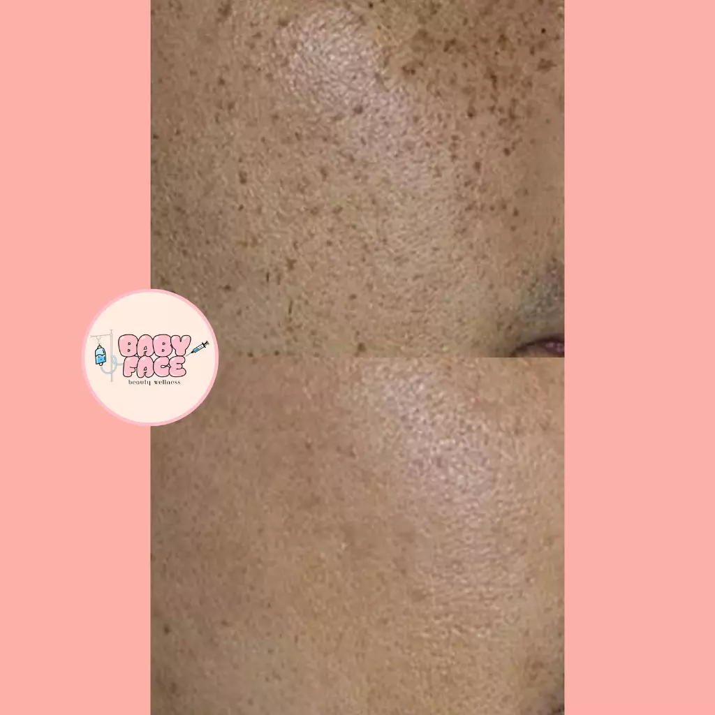 Before & After Epidermal Nevi: Mole Removal