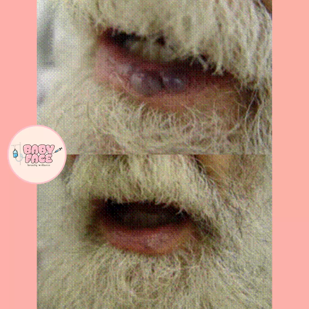 Before & After Laser Treatment for Vascular Lesions: Telangiectasia, Venous Lake & Cherry Hemangioma Removal