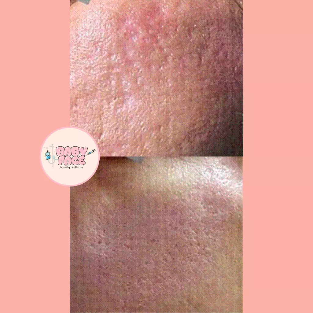 Before & After Laser Acne Scar Removal