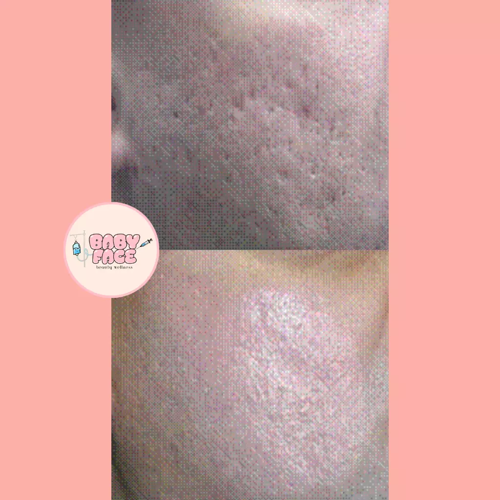 Before & After Laser Acne Scar Removal