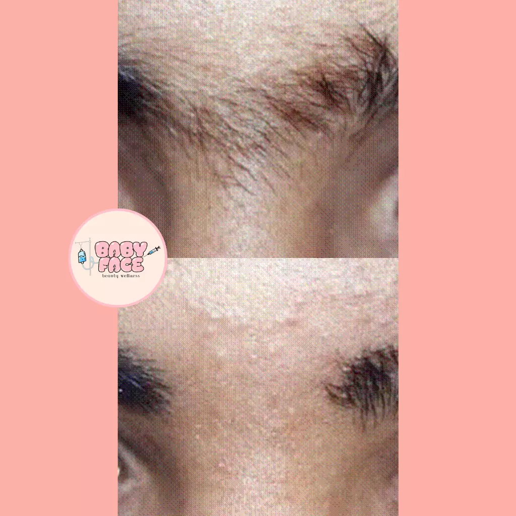 Before & After Laser Hair Removal