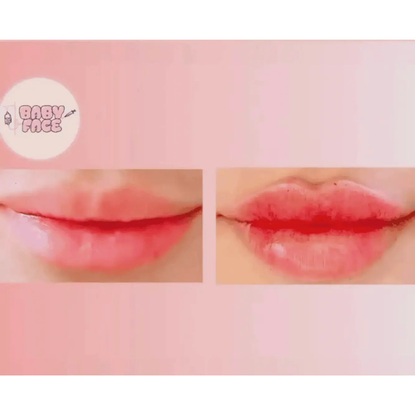 Before and after treatment of dermal filler in Costa Mesa, CA