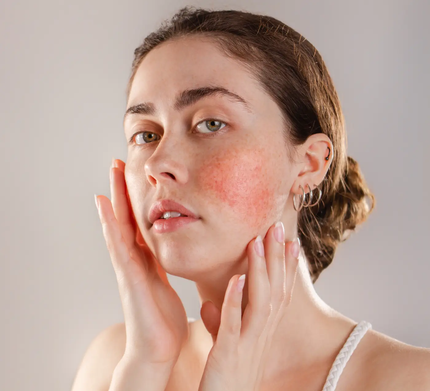 Rosacea Laser Treatment
