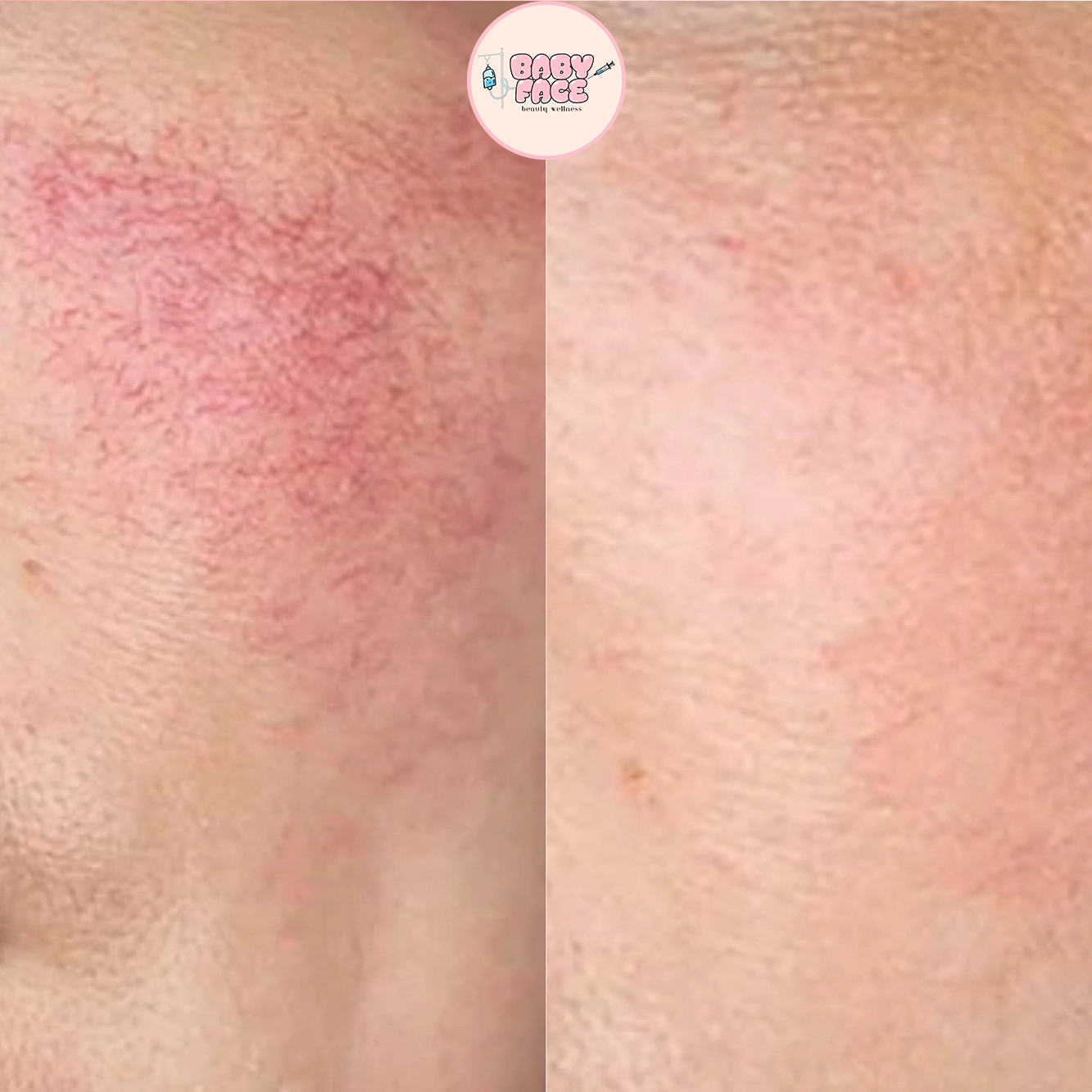 Before & After Rosacea Laser Treatment