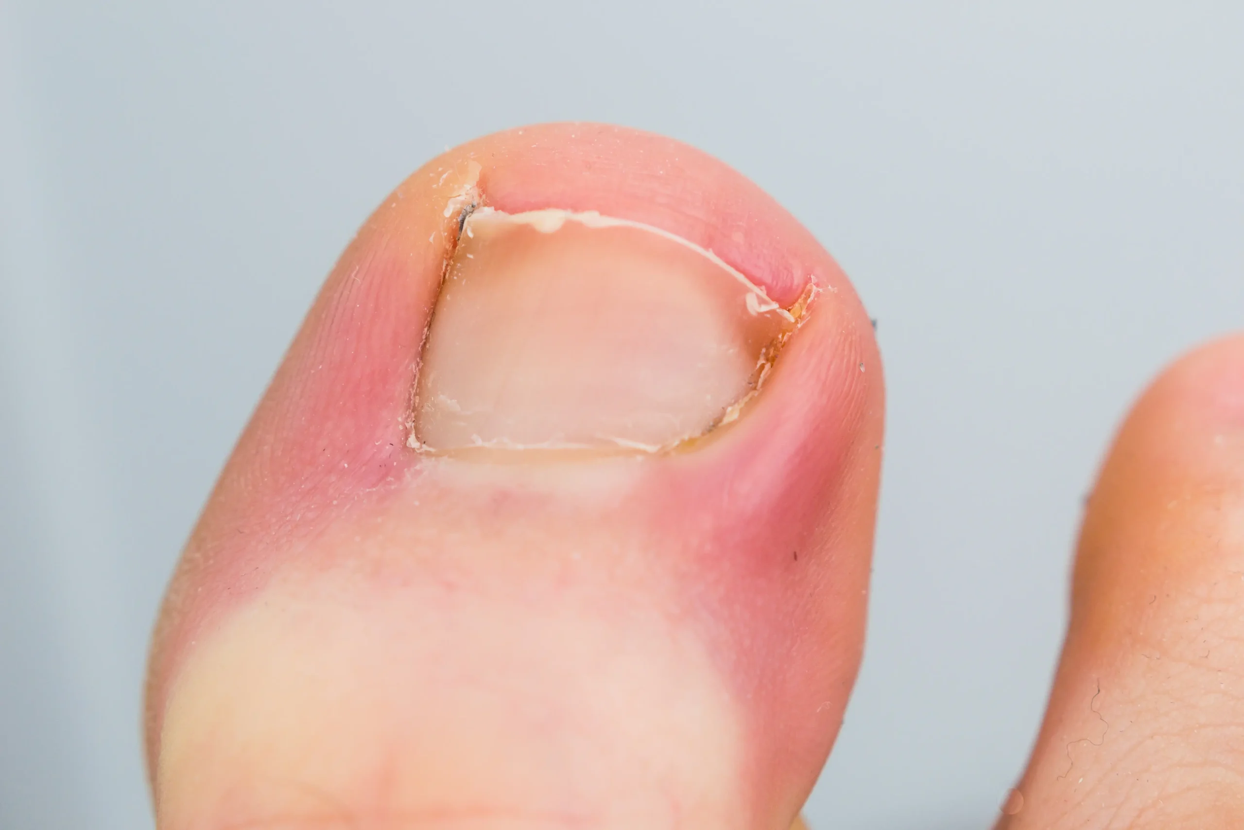 Laser Nail Fungus Removal