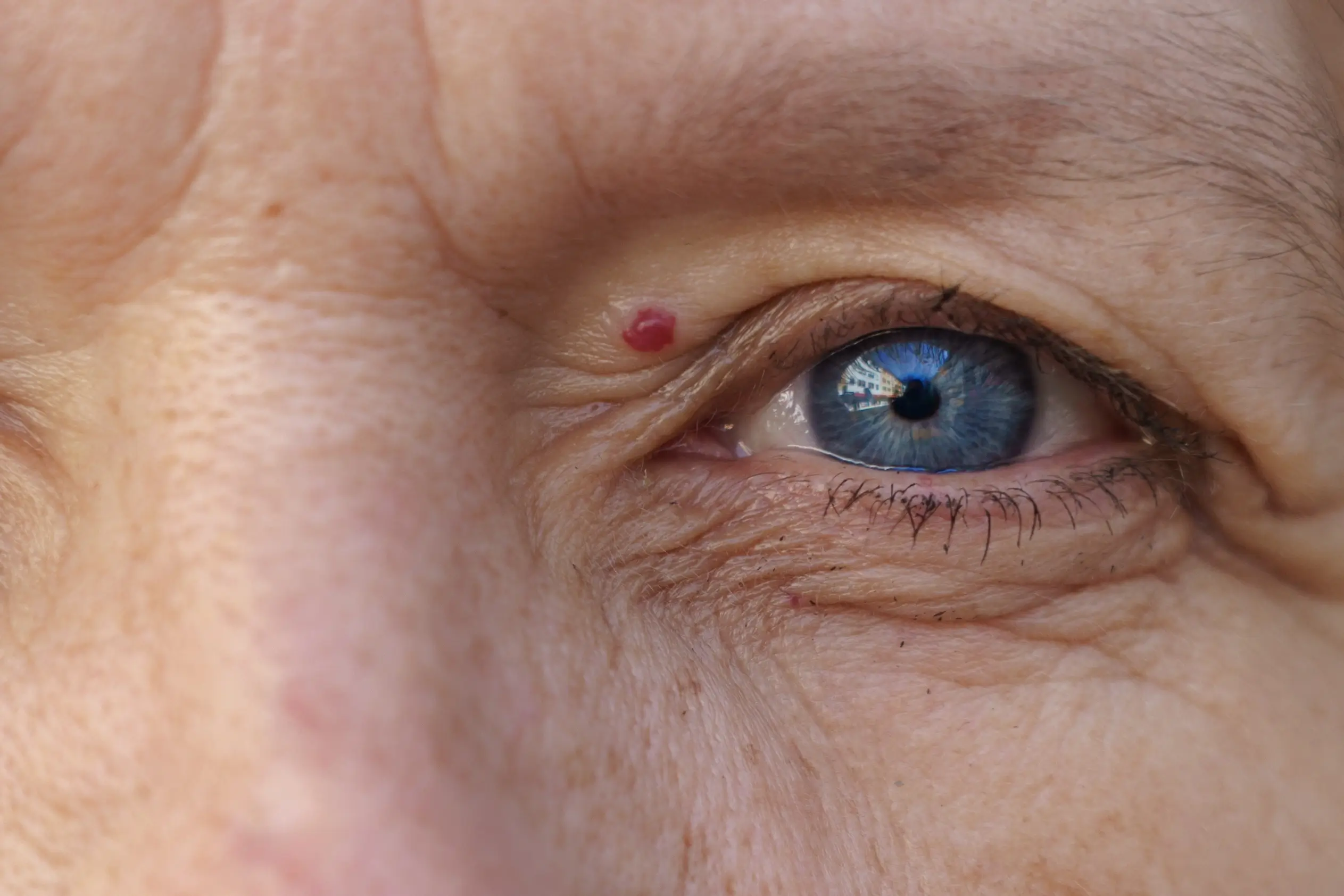 a close up of an eye with Hemangioma Treatment in Costa Mesa, CA