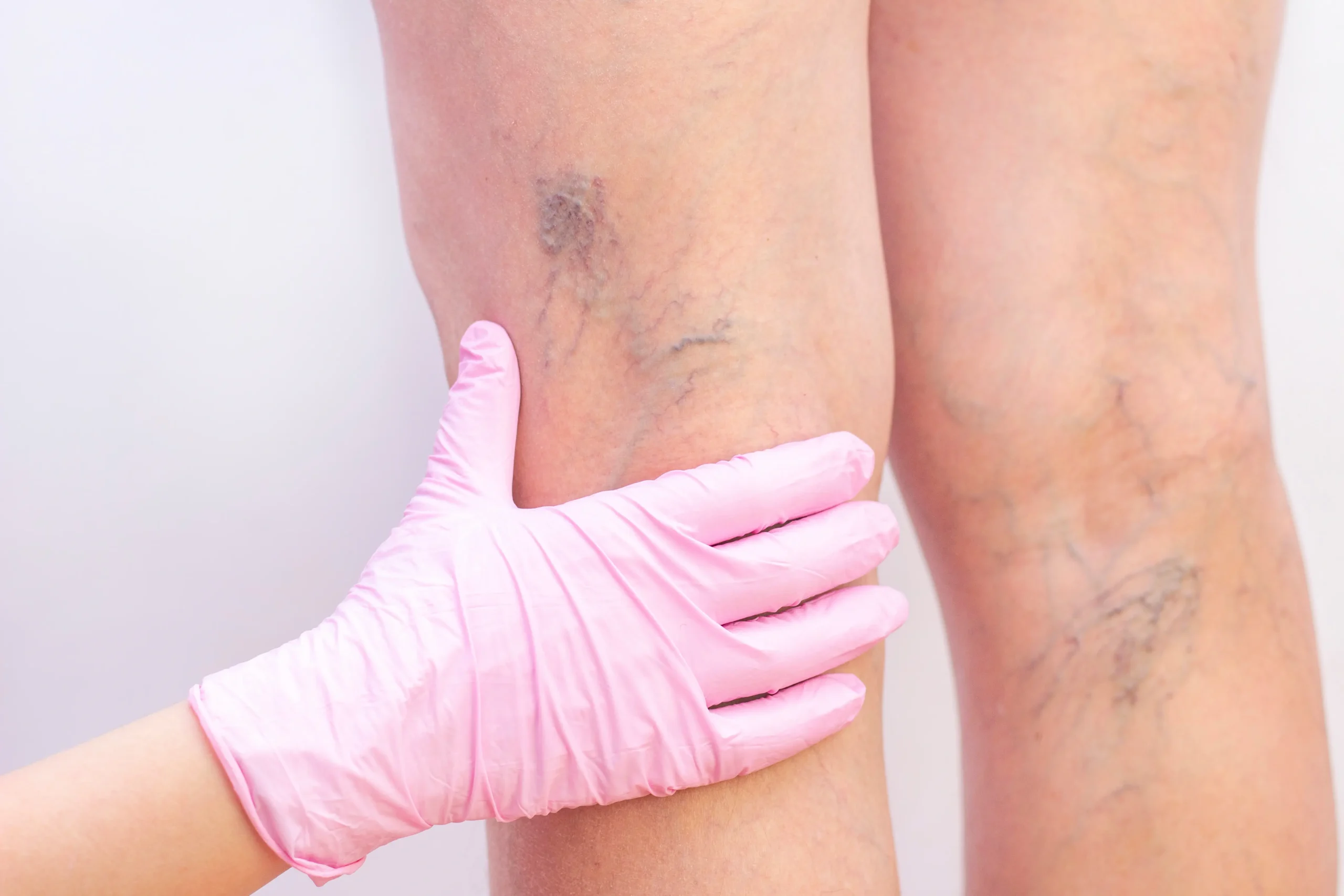 Checking for a varicose vein for Spider Veins treatment in Costa Mesa, CA