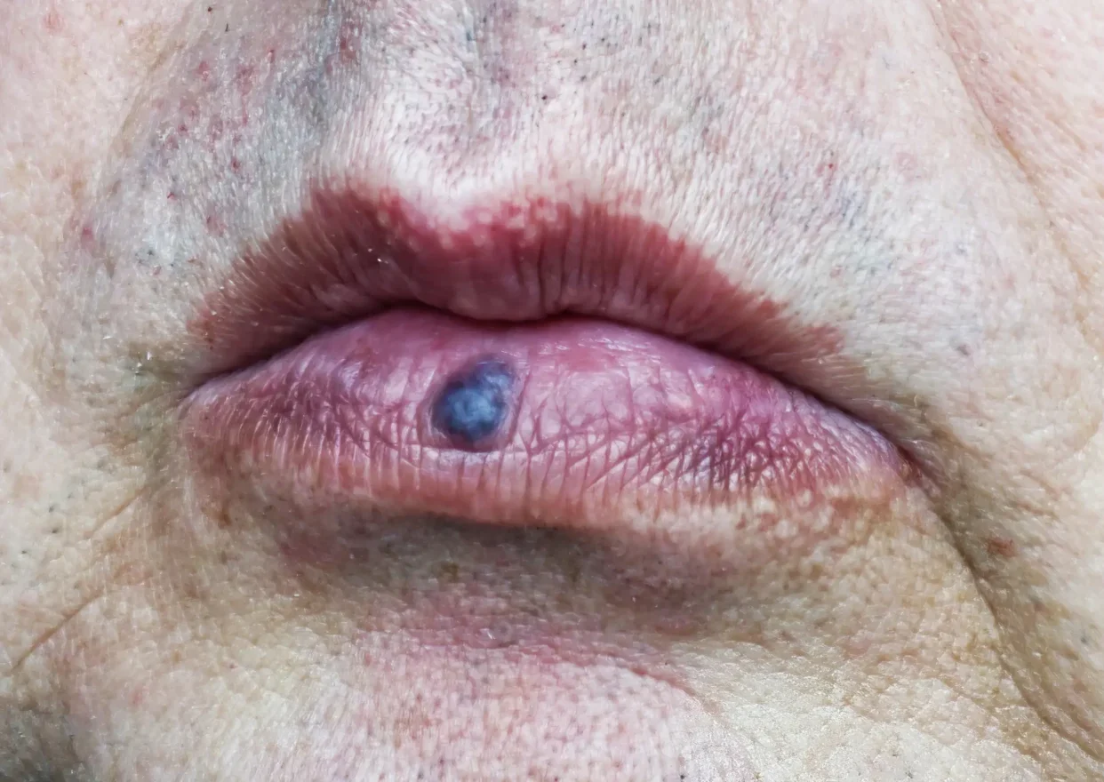 Venous Lake Treatment in Costa Mesa, CA