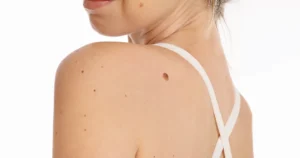Women receiving Skin Tag Removal in Costa Mesa, CA