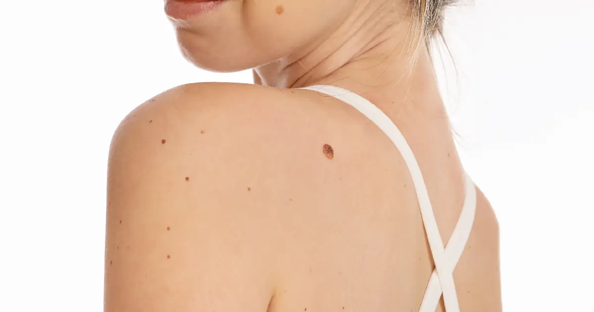 Women receiving Skin Tag Removal in Costa Mesa, CA