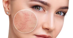 How Fotona Laser Treats Vascular Lesions: The Science Explained